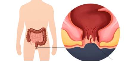 Anal Fissure Treatment